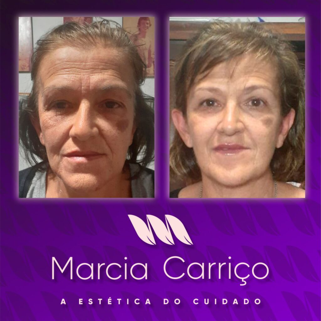 Tratamento de Melasma na Clínica Marcia Carriço em Indaiatuba